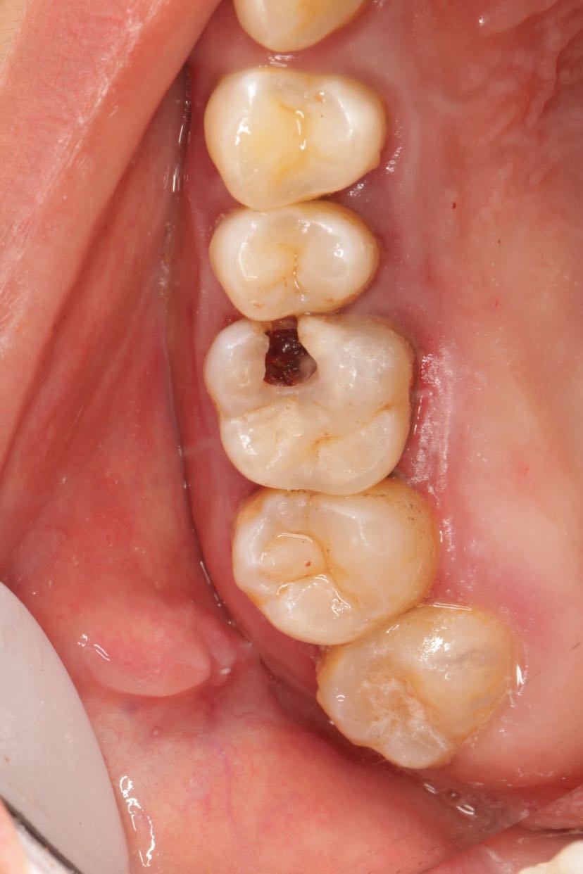 牙髓炎牙髓坏死牙髓病