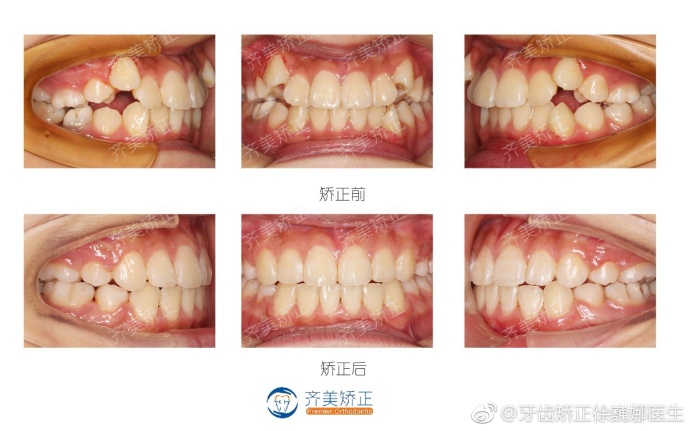 二,虎牙与双尖牙错位这位客人,三号牙和四号牙错位,前段牙弓间隙,后段