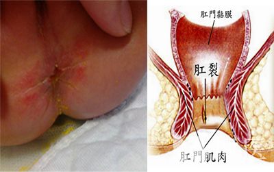 肛裂的症状三期图片