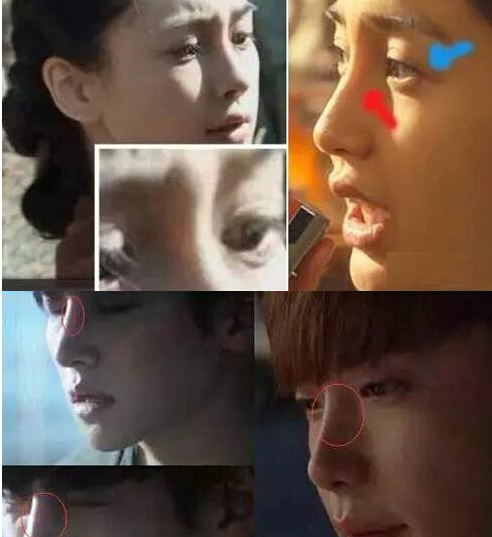 如何避免假体隆鼻透光?