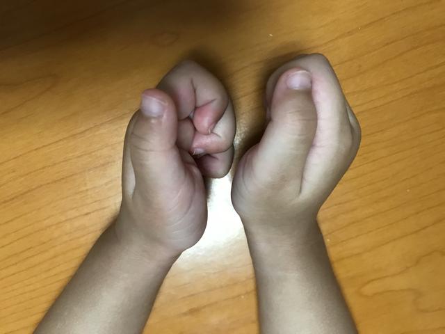 骨科医生告诉你:孩子大拇指老是伸不直,怎么回事?要不要治疗?