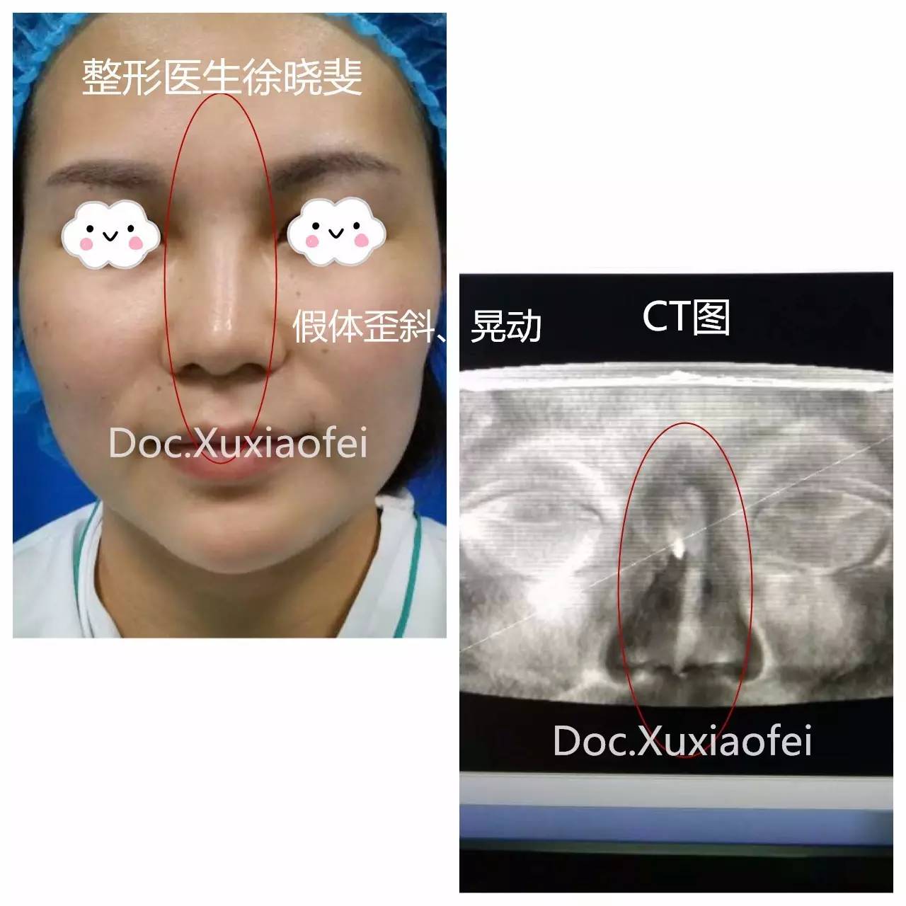 这个妹子8年前做过l硅胶假体隆鼻,这几年感觉鼻子越来越歪,还有假体