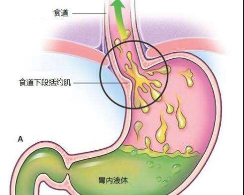 宝宝胃食管反流病有哪些症状