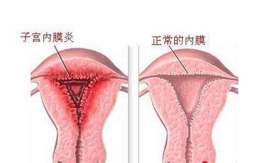 子宫内膜炎图片对比图片