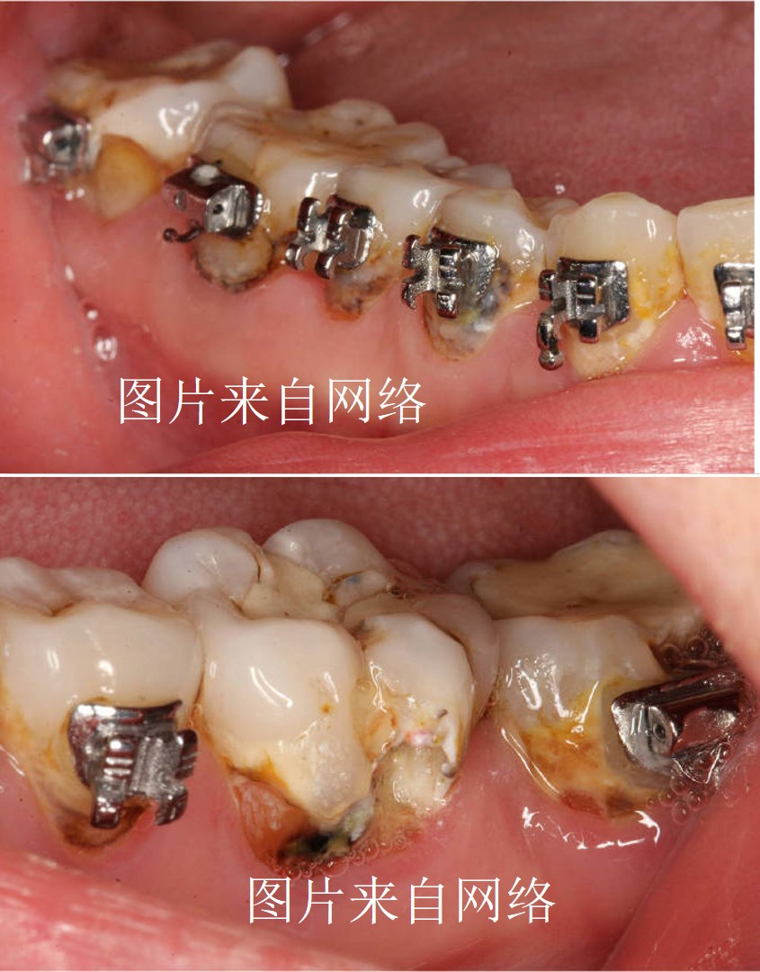 青少年透明牙套隱形矯治必讀附隱適美典型病例