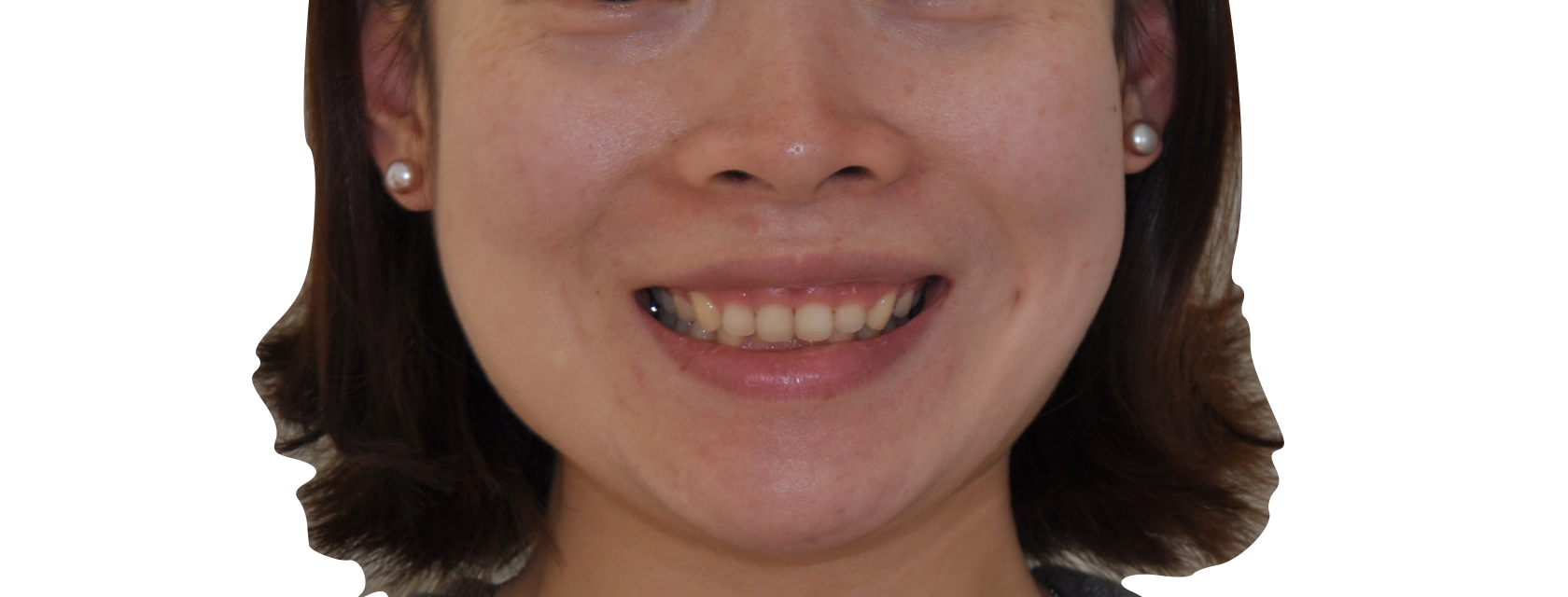 露龈笑常常伴随牙齿深覆合-就是上下牙咬住时,上牙完全包住了下牙