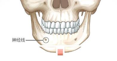 下巴截骨术图片