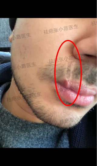 嘴唇上的疤痕有哪些治疗方法?我的情况有多难?