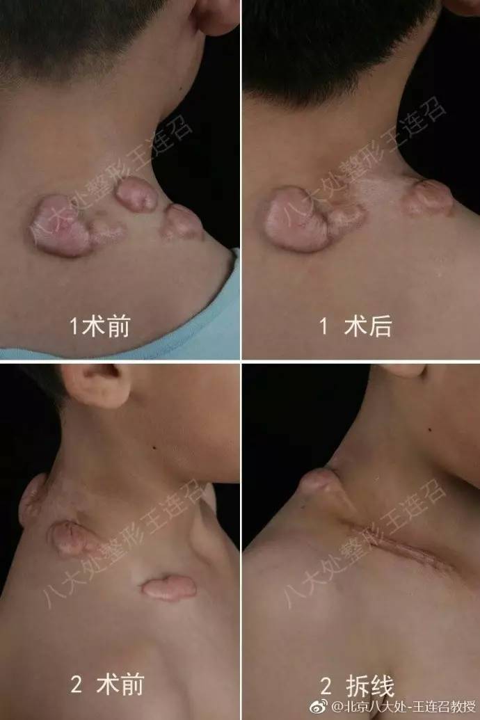 这个小患者因为瘢痕疙瘩严重影响到了生活质量,且孩子的瘢痕疙瘩所处