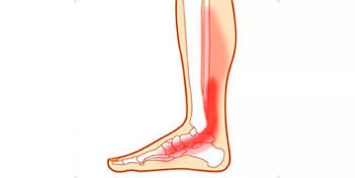 腱鞘炎脚部位置图片图片