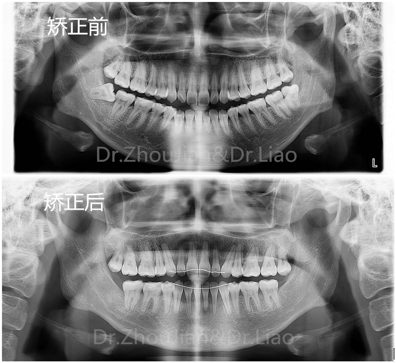 牙槽骨是身体里唯一一块在不断重建改造的骨头,牙齿移动终生都在进行