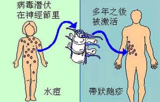 冬季,老年人为什么易发带状疱疹?