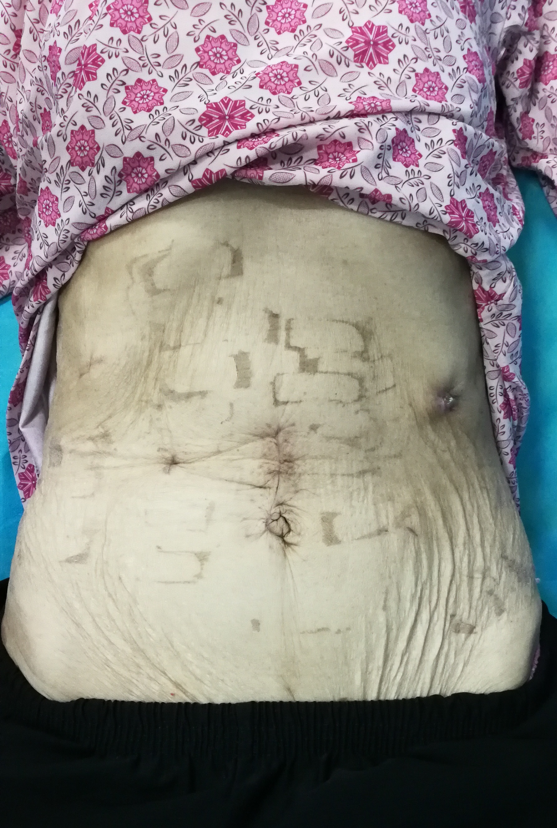 千万不要因为癌症患者年龄大就放弃!