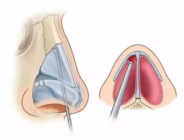 鼻中隔歪曲可以做鼻综合手术矫正吗?