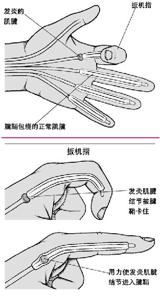 拇长屈肌腱鞘炎图片