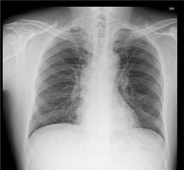 举个例子吧,大家去医院看病,一拍胸片,医生就说主动脉硬化,好多人就问