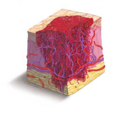 血管瘤它是怎么回事