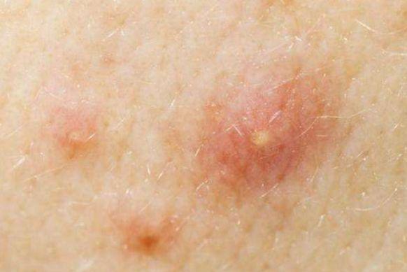 医生吧~~996994996994后期长出了脓头可不能"手贱"去挤它