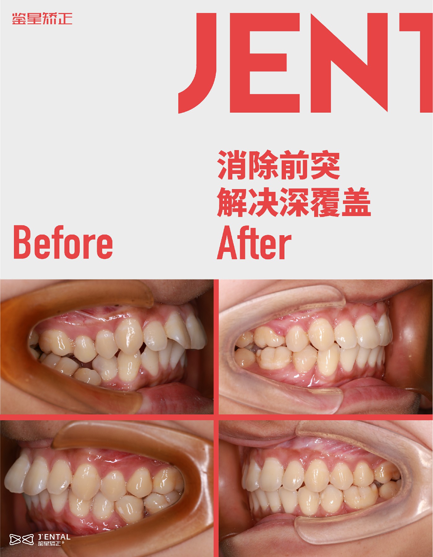 总之最好的避免牙根吸收的方式,还是定期口腔检查 专业正规的正畸医生