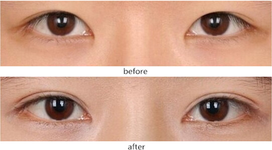 双眼皮做多宽最自然