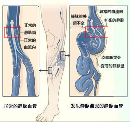 下肢靜脈曲張手術前,要做哪些準備?