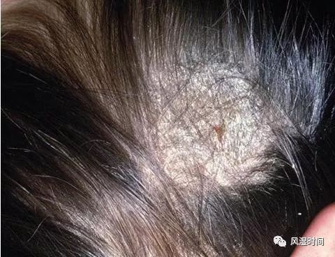 红斑狼疮与脱发-聂顺利主治医师-爱问医生
