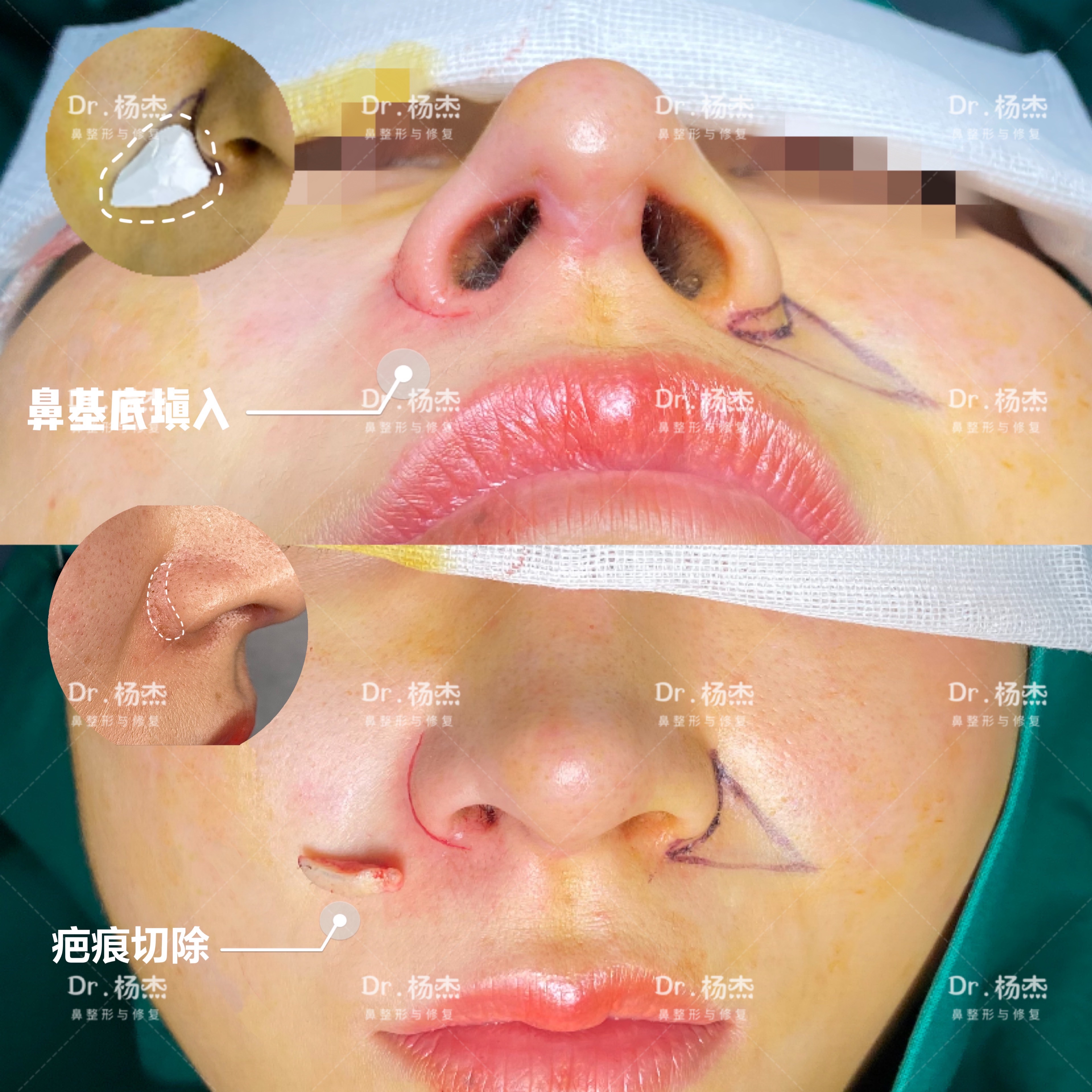 鼻基底凹陷的自测方法 - 知乎