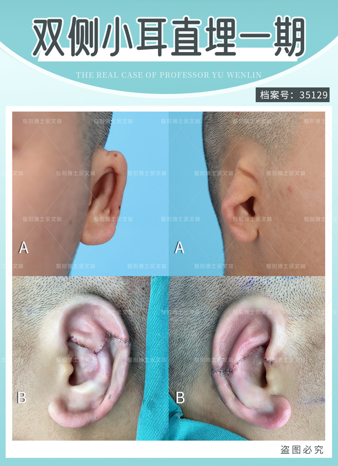 再造耳朵手术：耳再造方法的选择 - 哔哩哔哩