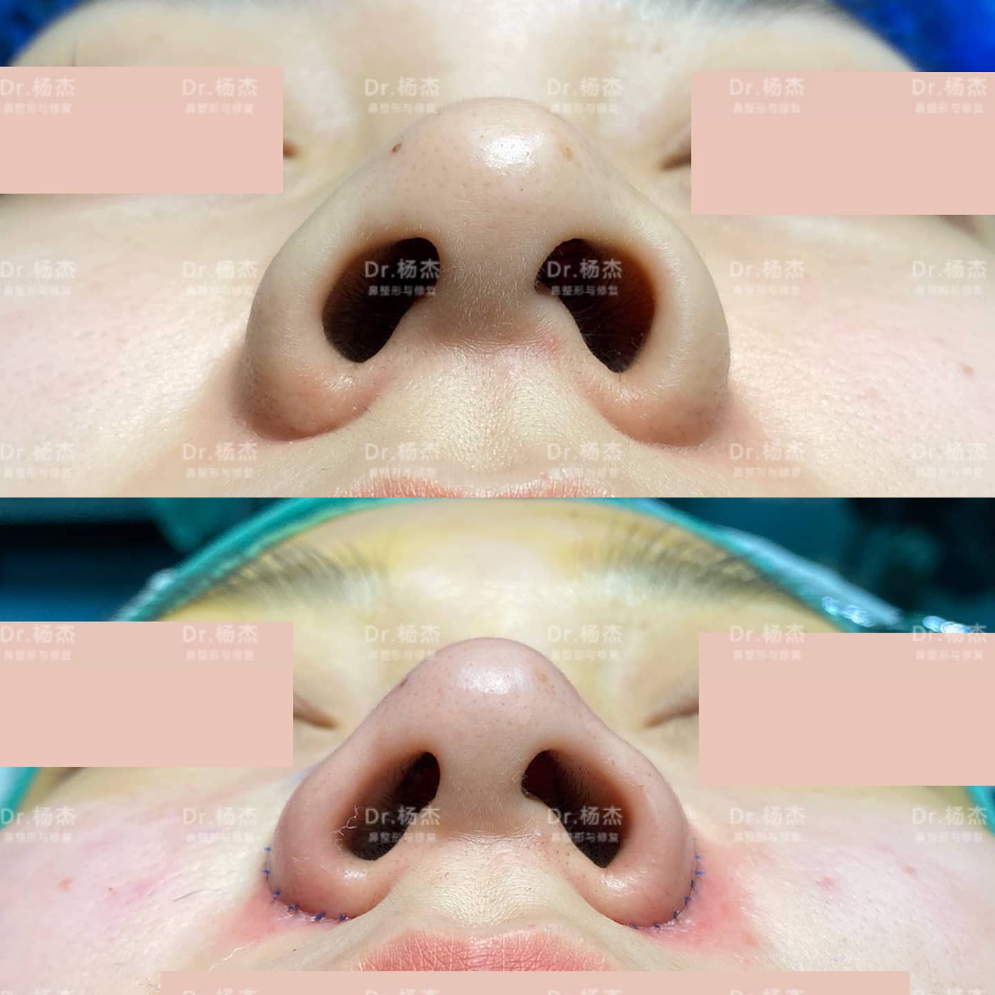 扁平矮塌鼻|鼻综合术后7天效果反馈-健康160