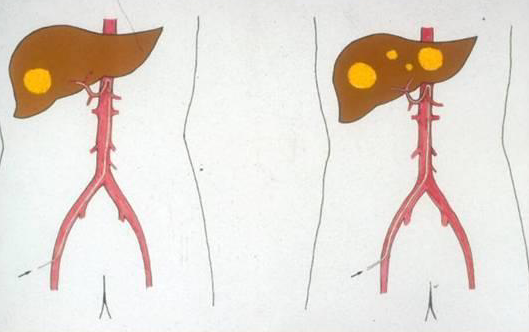 介入治療是怎樣用來治療肝癌的什麼情況下選擇介入效果最好