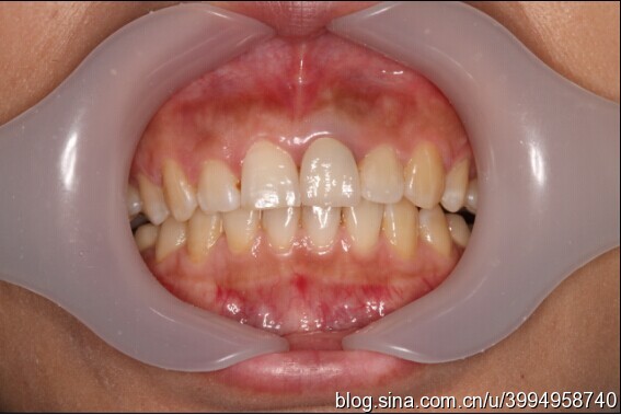 单颗前门牙全瓷修复仿真病例