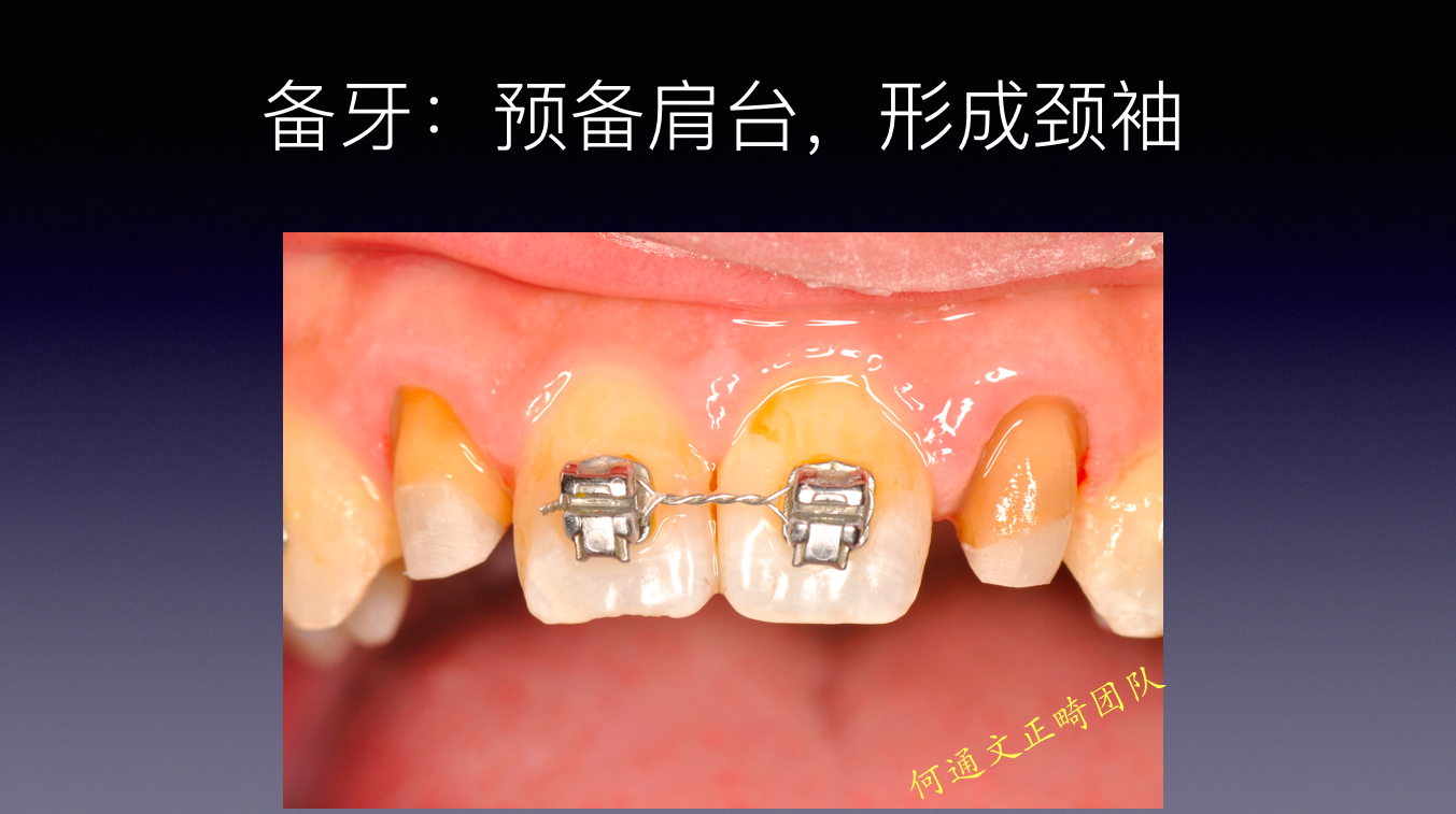 总结:12 22 残根位于龈缘下约3-4mm,如果不采用正畸牵引的方式将很难