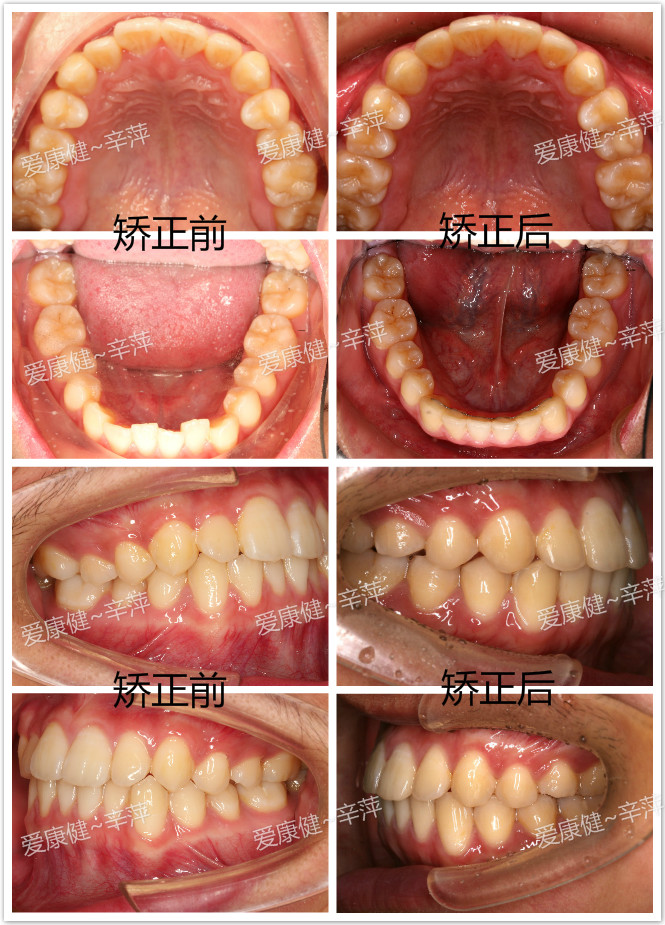 为什么儿童错颌畸形要早期矫治?