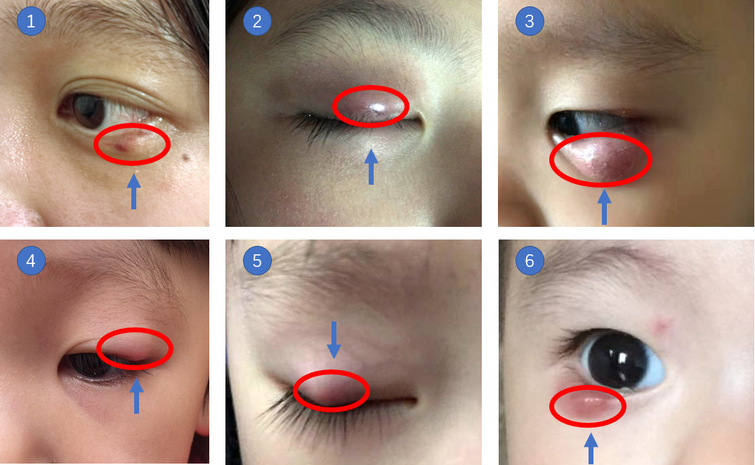 霰粒肿问答之三:中医如何治疗霰粒肿?