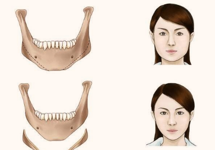 做完下颌角切除术,脸上的肉会垮下来吗?