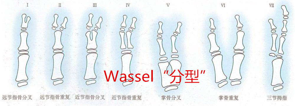儿童多指趾畸形切除矫形的美容要求