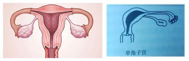 单角子宫怀孕图片