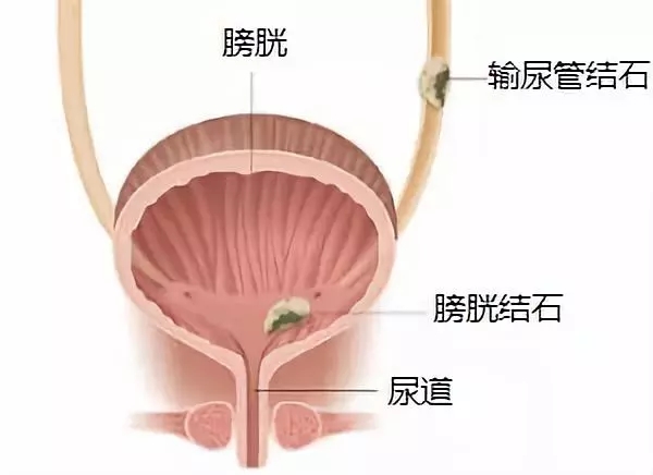 膀胱结石图片位置图图片