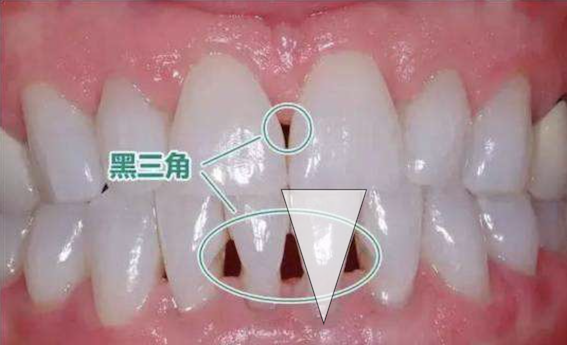 牙齿"黑三角"?你错怪矫正了!
