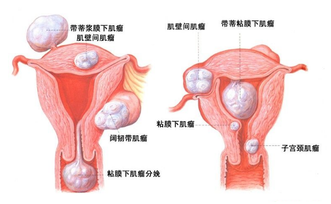 子宫肌瘤超过10公分了，必须要手术了吗？