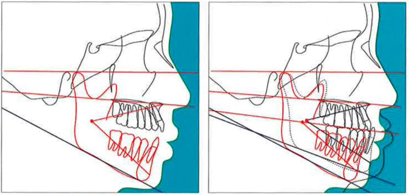 iii类病例的高度代偿