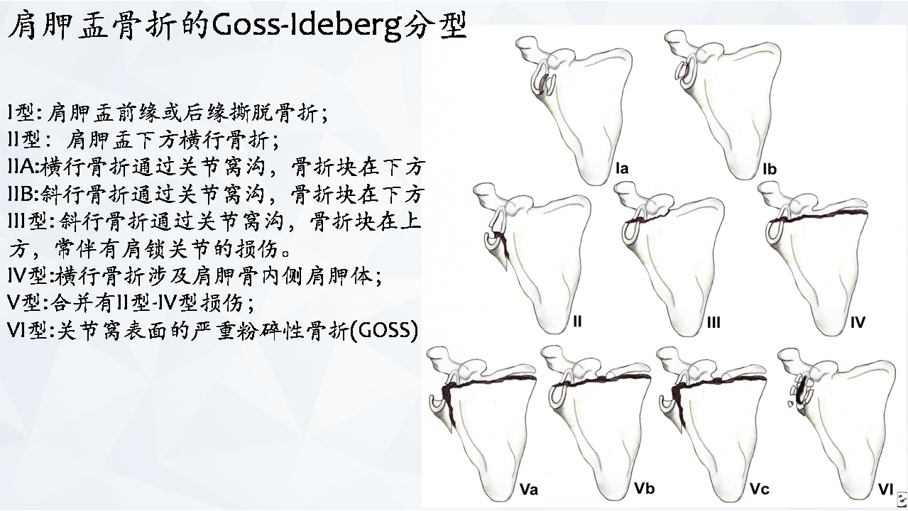 涨知识肩胛骨骨折分型