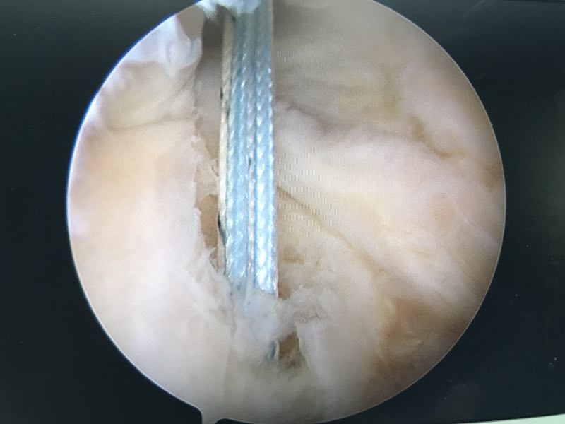 圖2,通過後內側路開孔如圖1可見,她的內側半月板後根完全斷掉,並且有