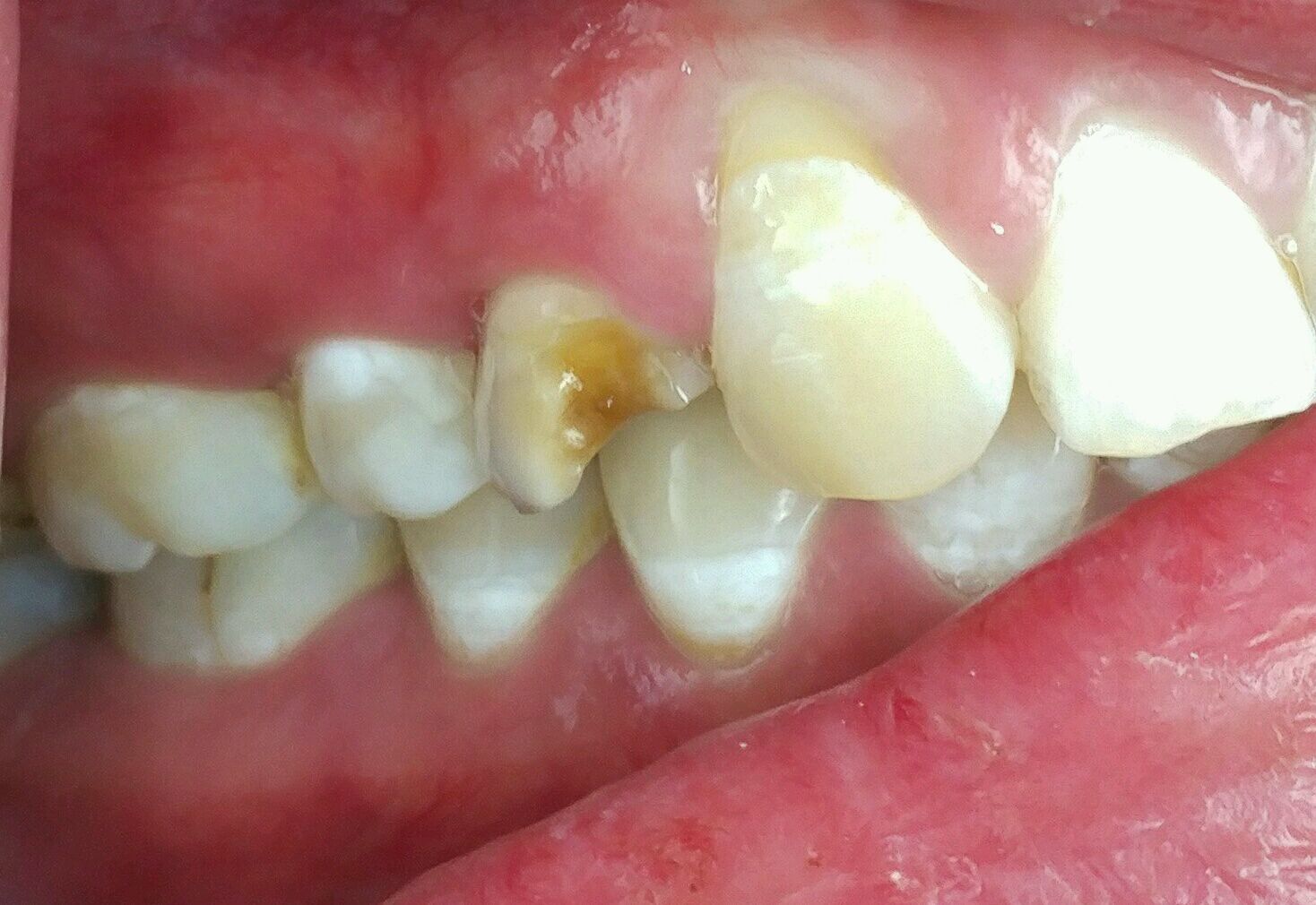 牙骨质结构不良图片图片