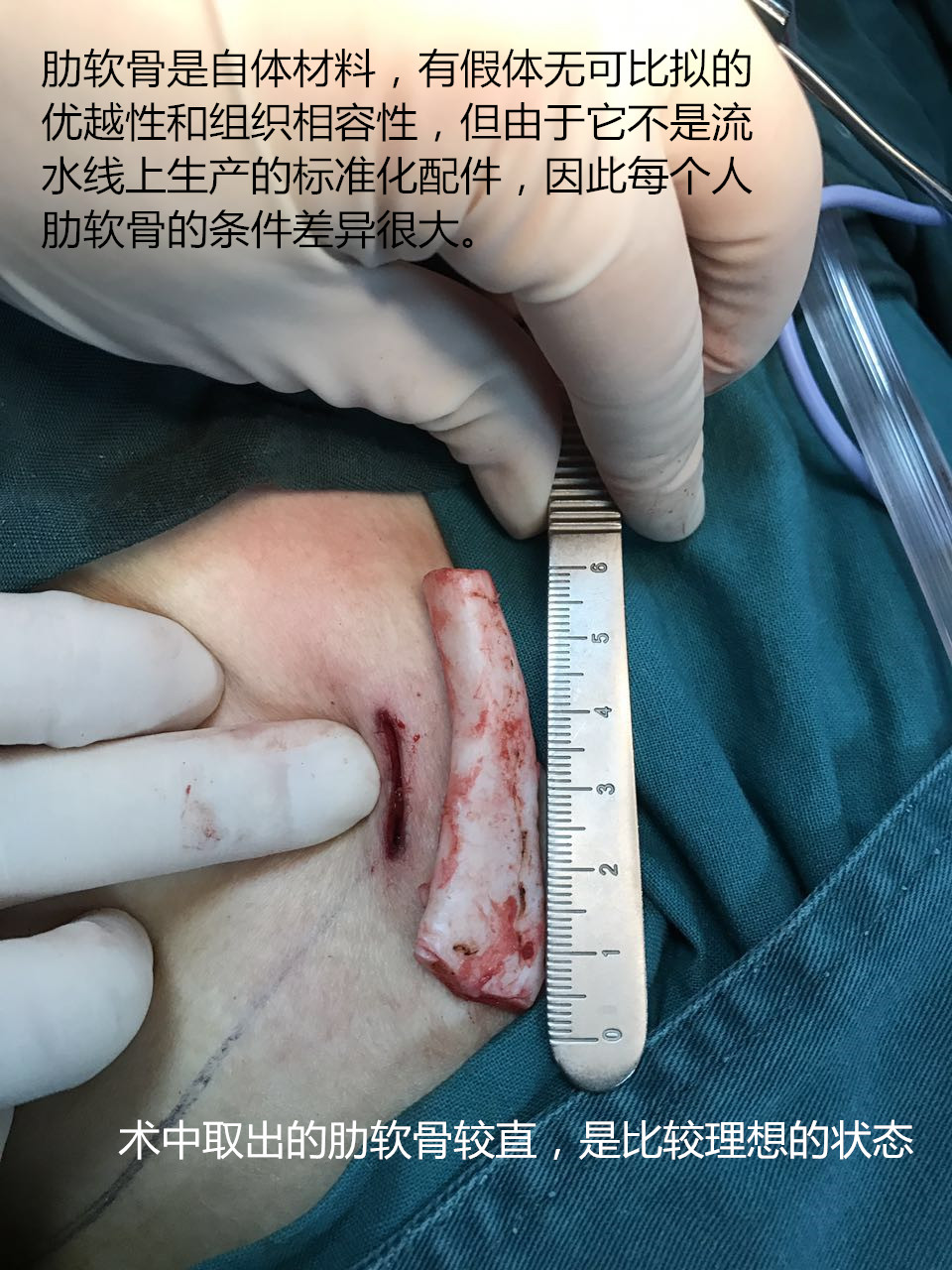 肋软骨隆鼻疤痕详解