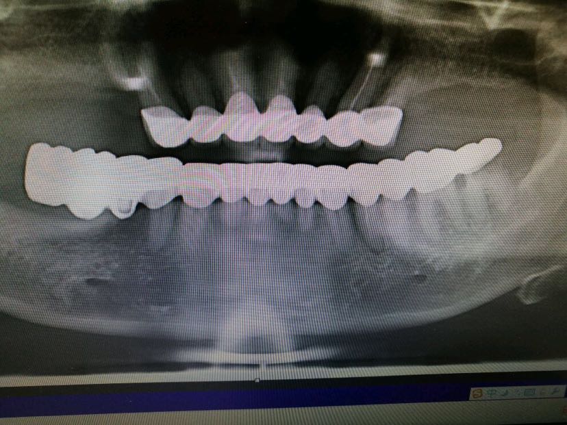 种植牙虽好,烤瓷桥真的有那么不堪吗?