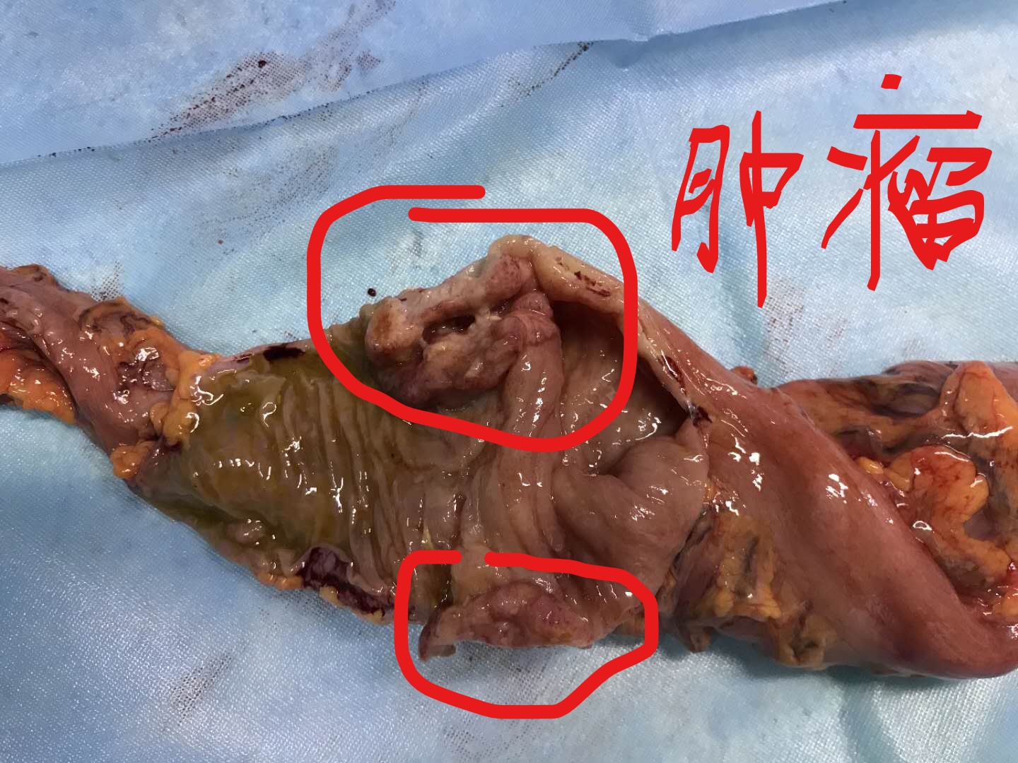 结肠浆膜图片