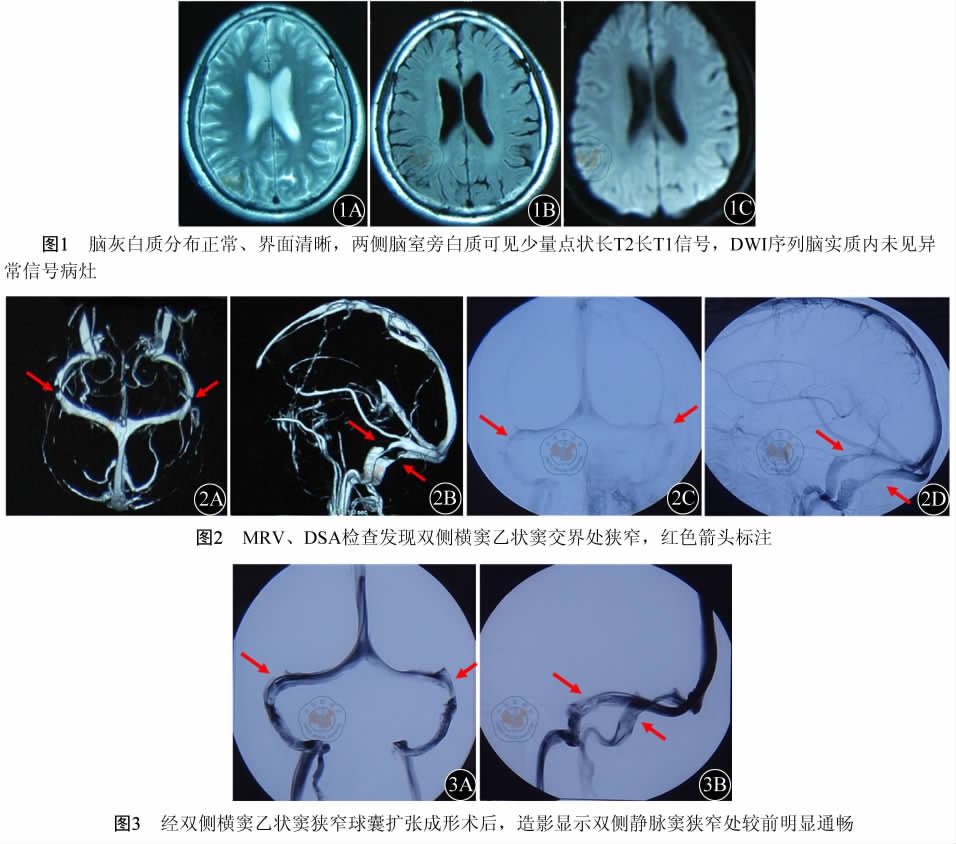 良性颅高压综合征与静脉窦狭窄