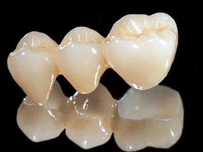 二氧化锆全瓷牙使牙齿颜色的自然感觉和不明显的牙冠边缘,尤其是对