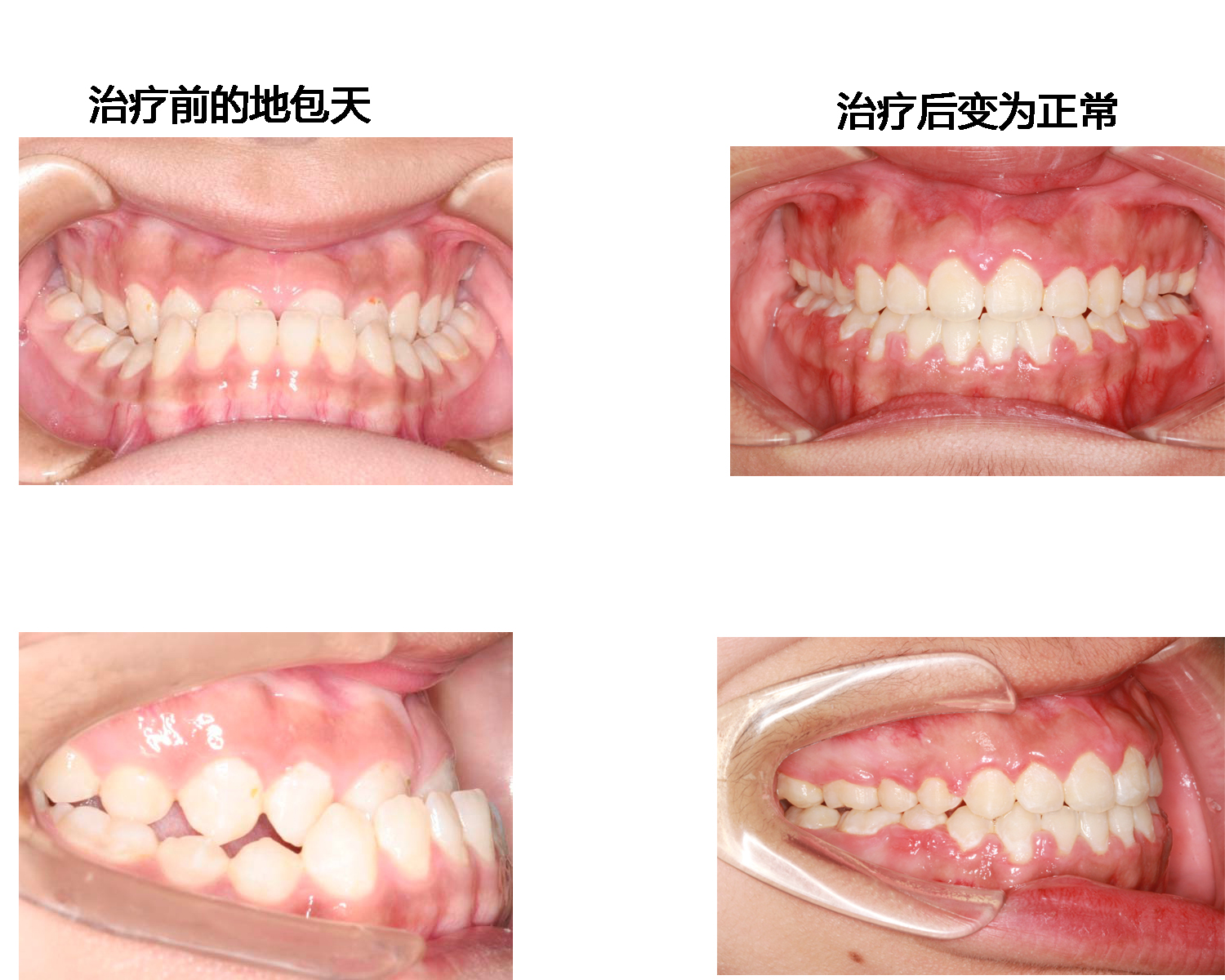 牙齿矫正